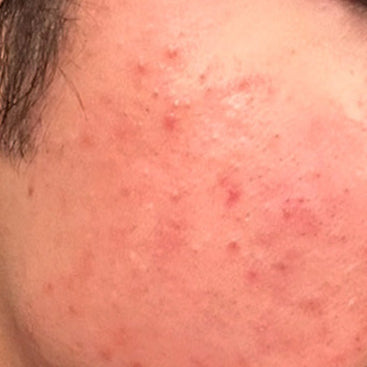 Skin after