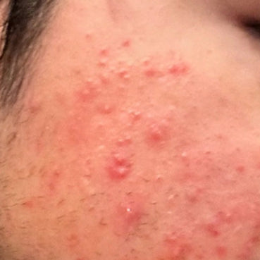 Skin before